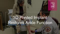 3D Printed Implant Restores Ankle Function
