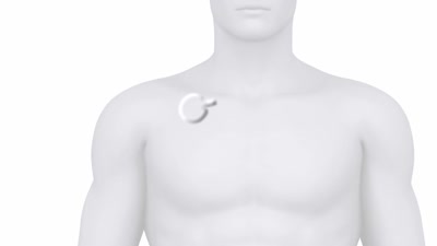 Port-a-Cath (Implanted Vascular Access Device)